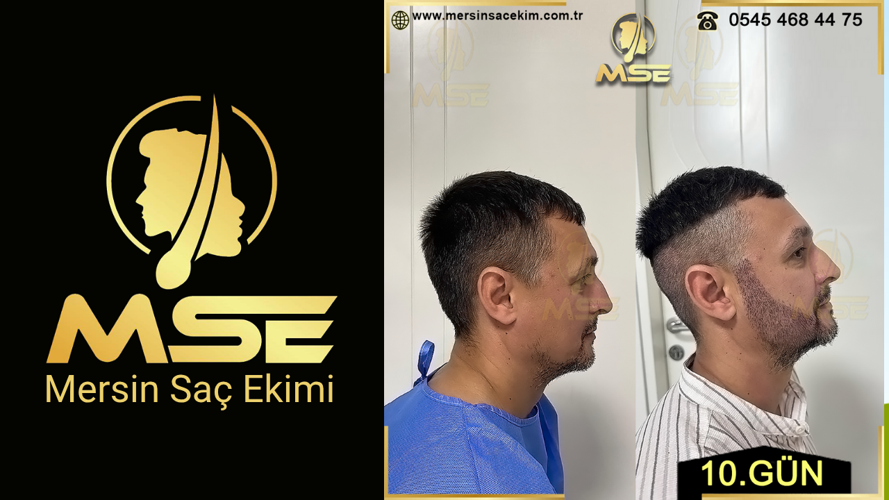 MERSİN SAÇ EKİMİ